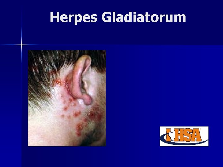 Herpes Gladiatorum 