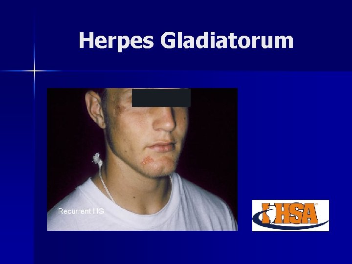 Herpes Gladiatorum 
