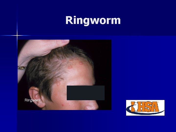 Common skin conditions in wrestling Ringworm Impetigo Mulluscum