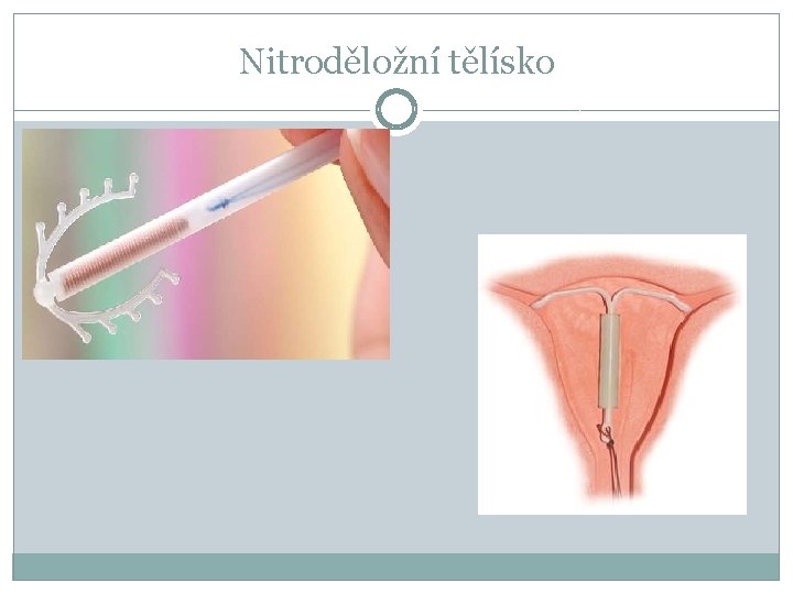 Nitroděložní tělísko 