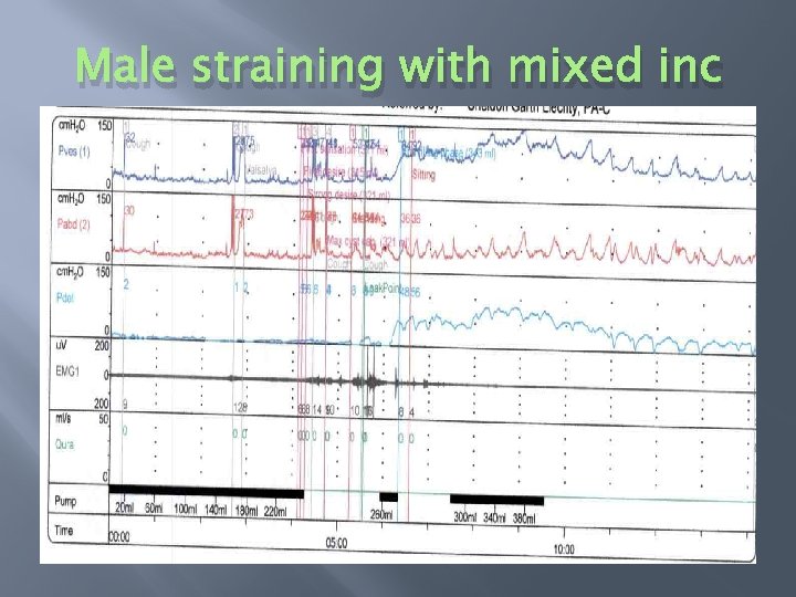 Male straining with mixed inc 