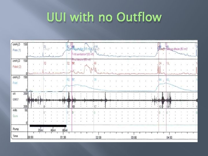 UUI with no Outflow 