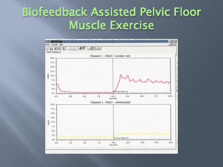 Biofeedback Assisted Pelvic Floor Muscle Exercise 