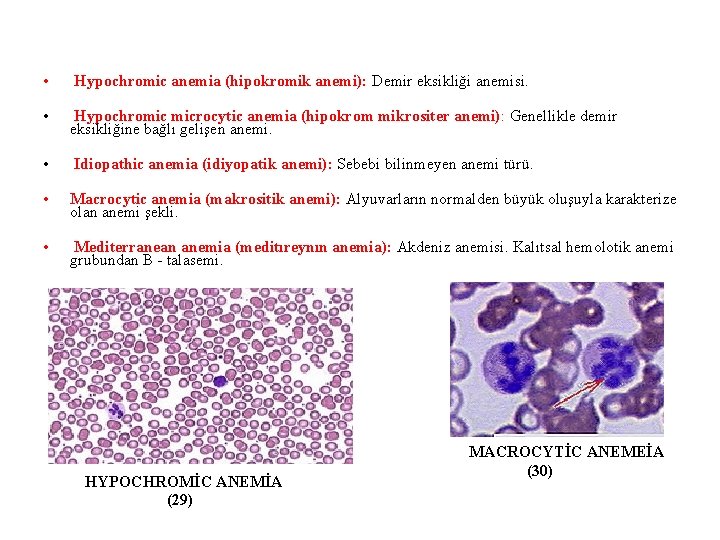  • Hypochromic anemia (hipokromik anemi): Demir eksikliği anemisi. • Hypochromic microcytic anemia (hipokrom