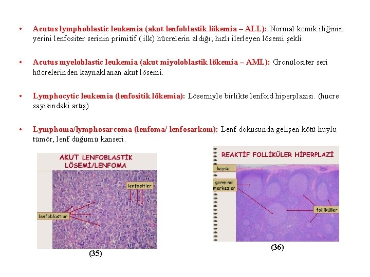  • Acutus lymphoblastic leukemia (akut lenfoblastik lökemia – ALL): Normal kemik iliğinin yerini