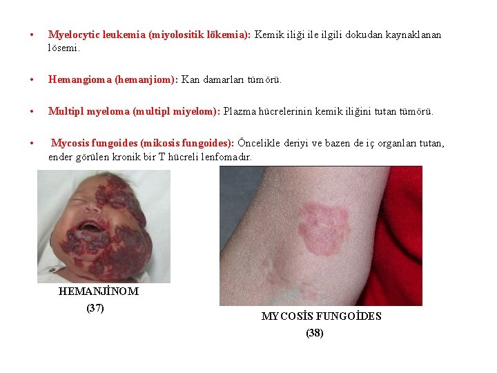  • Myelocytic leukemia (miyolositik lökemia): Kemik iliği ile ilgili dokudan kaynaklanan lösemi. •
