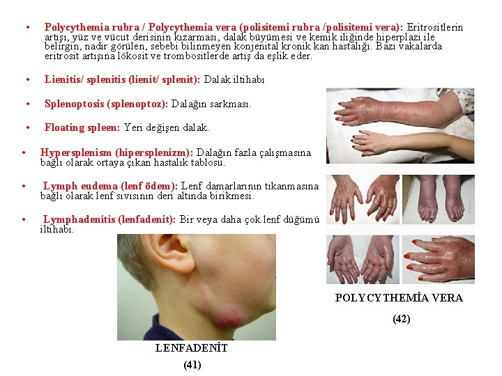  • Polycythemia rubra / Polycythemia vera (polisitemi rubra /polisitemi vera): Eritrositlerin artışı, yüz