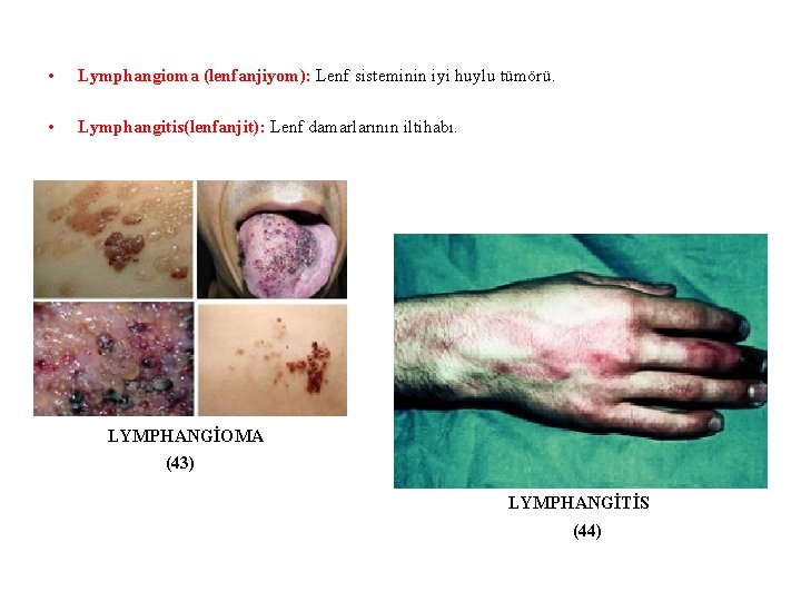  • Lymphangioma (lenfanjiyom): Lenf sisteminin iyi huylu tümörü. • Lymphangitis(lenfanjit): Lenf damarlarının iltihabı.