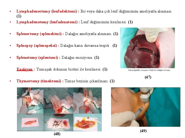  • • Lymphadenectomy (lenfadektomi) : Bir veya daha çok lenf düğümünün ameliyatla alınması.