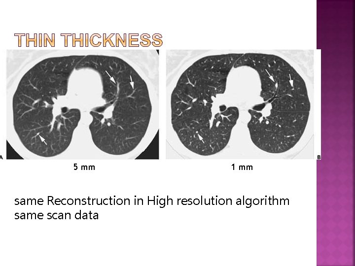 5 mm 1 mm same Reconstruction in High resolution algorithm same scan data 