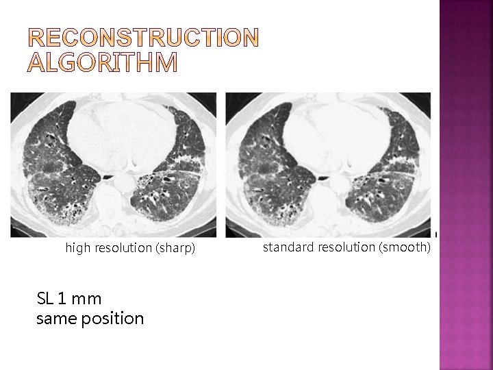 high resolution (sharp) SL 1 mm same position standard resolution (smooth) 