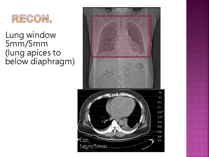 Lung window 5 mm/5 mm (lung apices to below diaphragm) Cor. 5 mm/5 mm