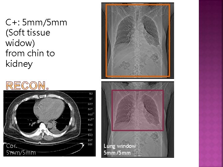 C+: 5 mm/5 mm (Soft tissue widow) from chin to kidney Cor. 5 mm/5