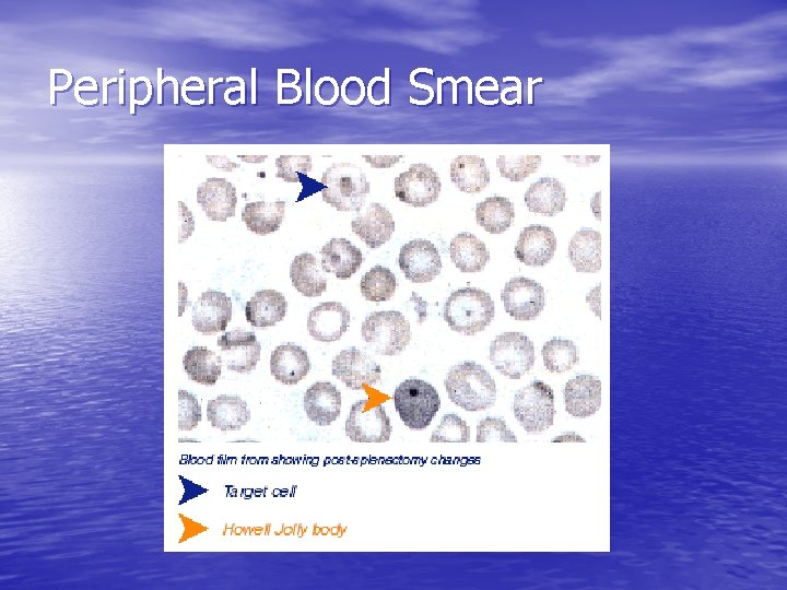 Peripheral Blood Smear 