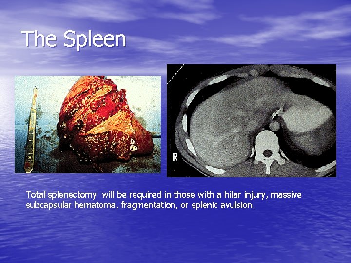 The Spleen Total splenectomy will be required in those with a hilar injury, massive