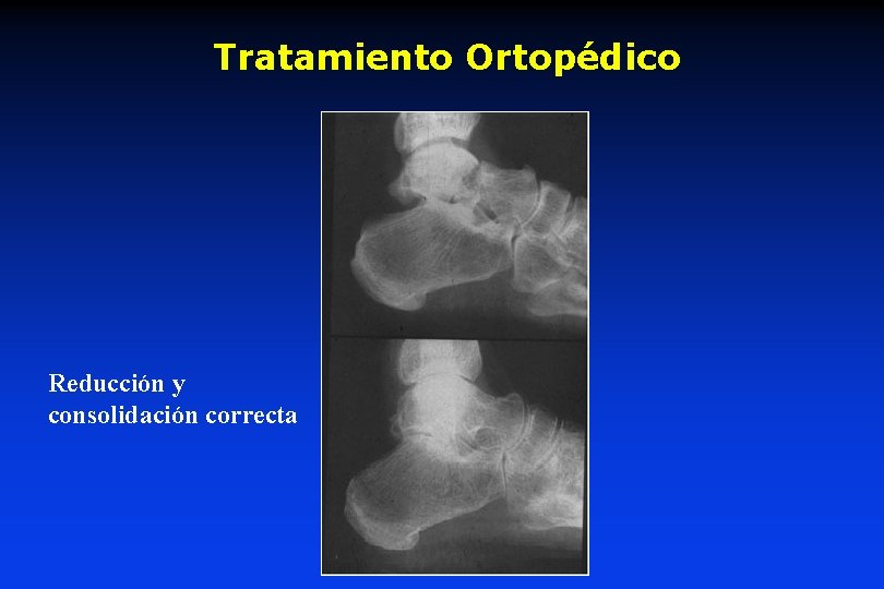 Tratamiento Ortopédico Reducción y consolidación correcta 