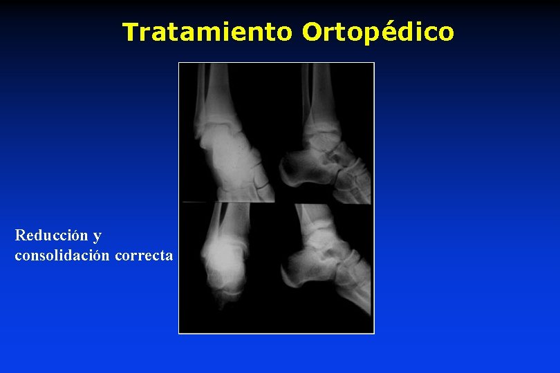 Tratamiento Ortopédico Reducción y consolidación correcta 