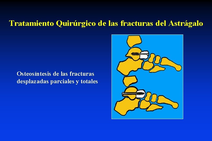 Tratamiento Quirúrgico de las fracturas del Astrágalo Osteosíntesis de las fracturas desplazadas parciales y