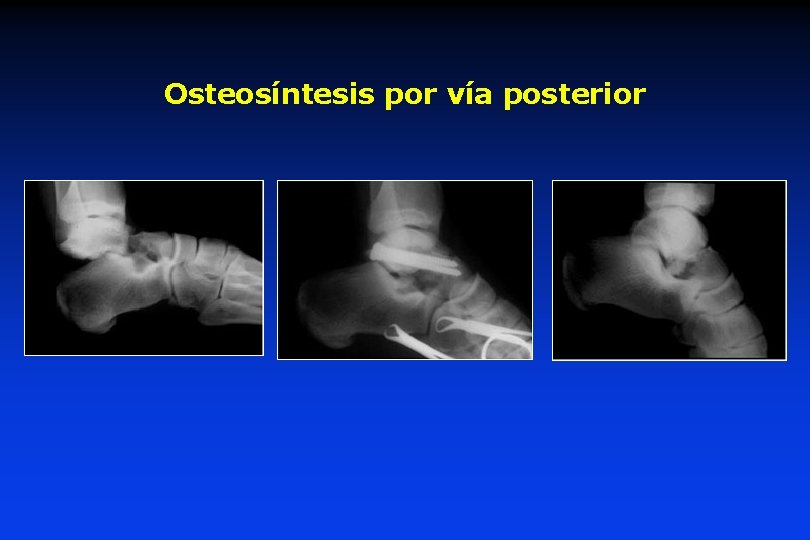 Osteosíntesis por vía posterior 