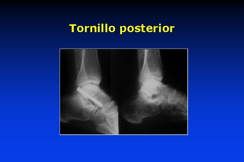 Tornillo posterior 