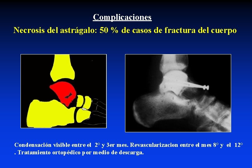 Complicaciones Necrosis del astrágalo: 50 % de casos de fractura del cuerpo Condensación visible