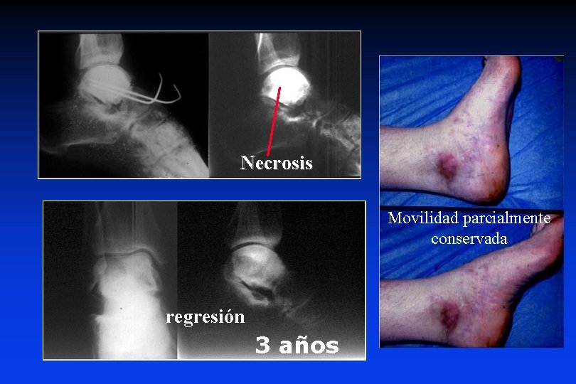 Necrosis Movilidad parcialmente conservada regresión 3 años 