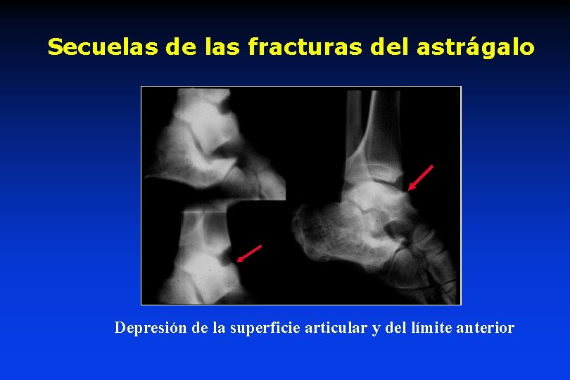 Secuelas de las fracturas del astrágalo Depresión de la superficie articular y del límite