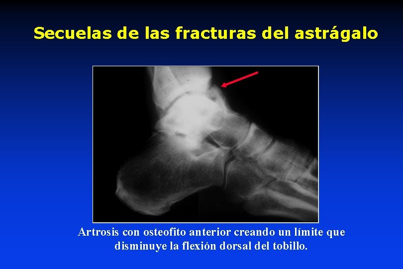 Secuelas de las fracturas del astrágalo Artrosis con osteofito anterior creando un límite que