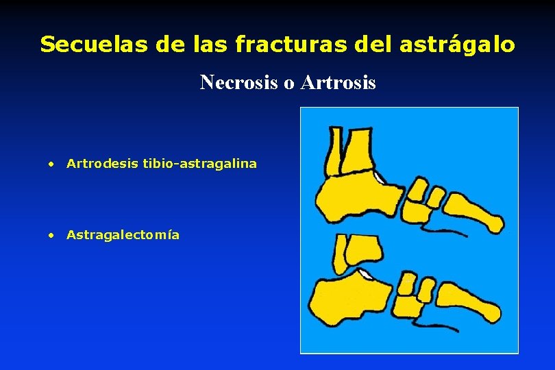 Secuelas de las fracturas del astrágalo Necrosis o Artrosis • Artrodesis tibio-astragalina • Astragalectomía