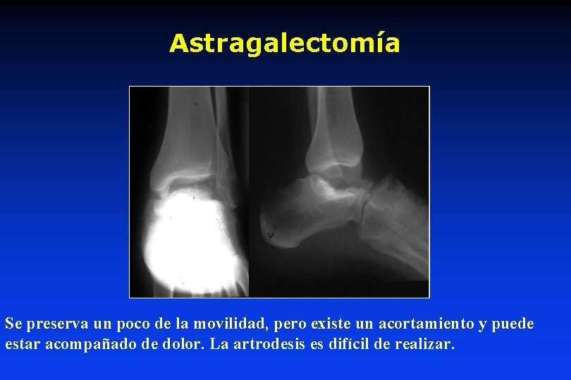 Astragalectomía Se preserva un poco de la movilidad, pero existe un acortamiento y puede