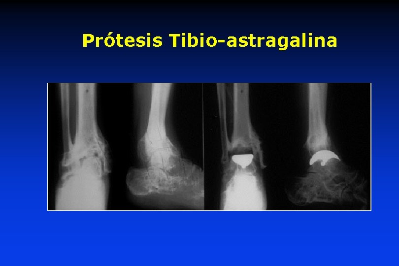 Prótesis Tibio-astragalina 