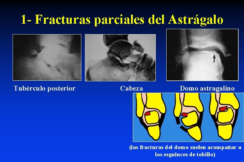1 - Fracturas parciales del Astrágalo Tubérculo posterior Cabeza Domo astragalino (las fracturas del
