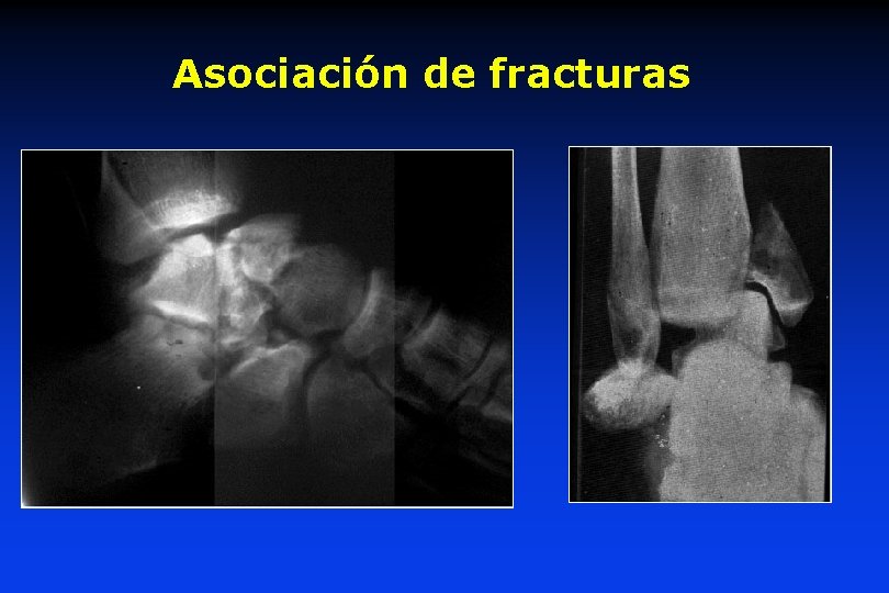 Asociación de fracturas 