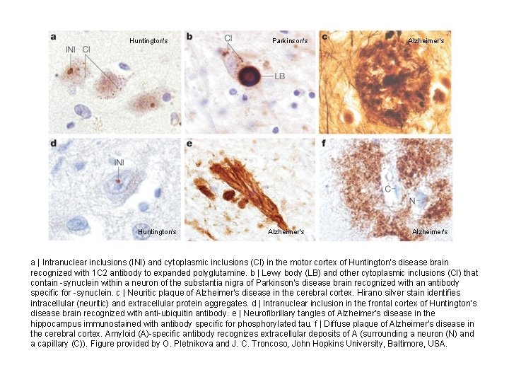 Huntington's Parkinson's Alzheimer's a | Intranuclear inclusions (INI) and cytoplasmic inclusions (CI) in the