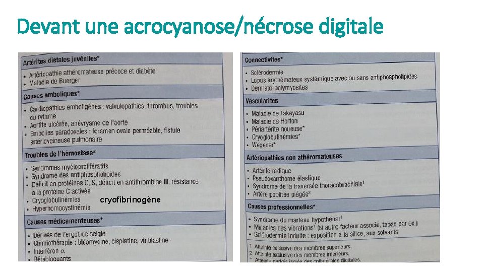 Devant une acrocyanose/nécrose digitale cryofibrinogène 