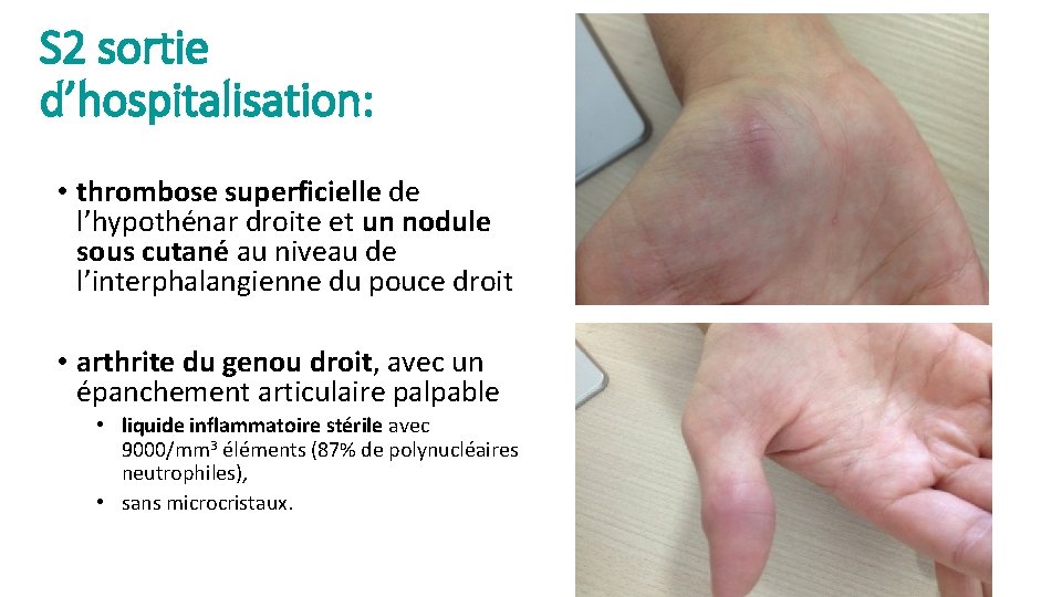 S 2 sortie d’hospitalisation: • thrombose superficielle de l’hypothénar droite et un nodule sous