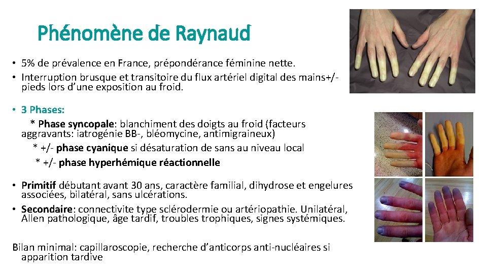Phénomène de Raynaud • 5% de prévalence en France, prépondérance féminine nette. • Interruption