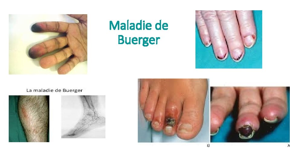 Maladie de Buerger 