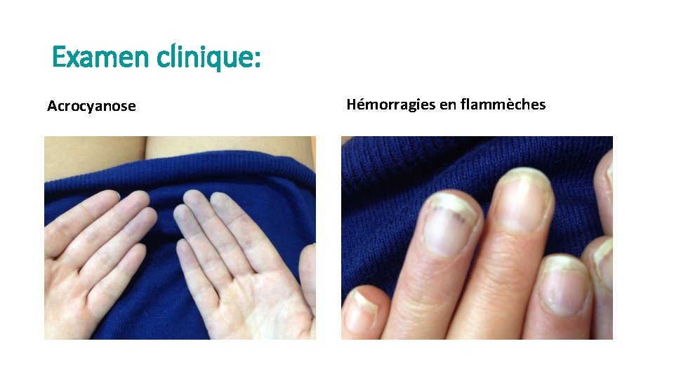 Examen clinique: Acrocyanose Hémorragies en flammèches 