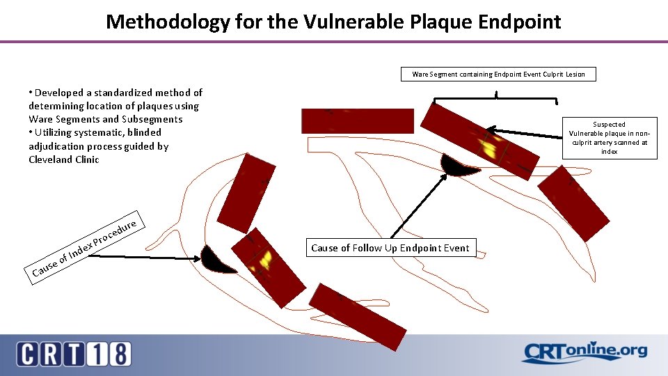 Methodology for the Vulnerable Plaque Endpoint Ware Segment containing Endpoint Event Culprit Lesion •