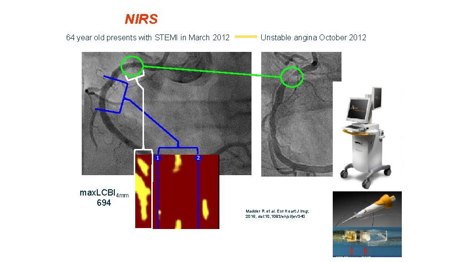 NIRS 64 year old presents with STEMI in March 2012 Unstable angina October 2012