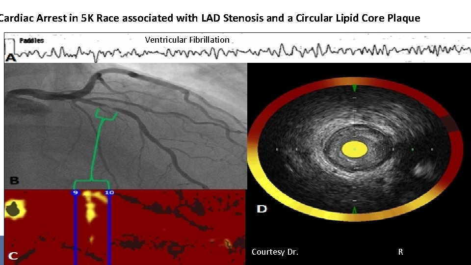Cardiac Arrest in 5 K Race associated with LAD Stenosis and a Circular Lipid
