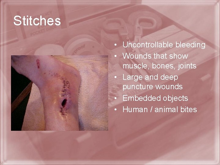 Stitches • Uncontrollable bleeding • Wounds that show muscle, bones, joints • Large and