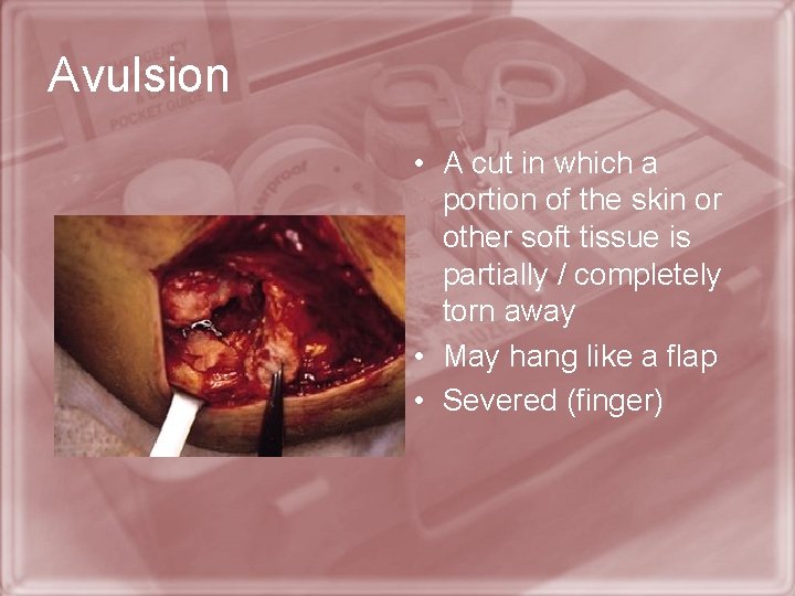 Avulsion • A cut in which a portion of the skin or other soft