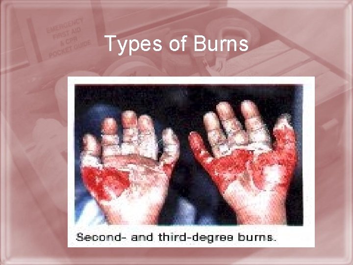 Types of Burns 