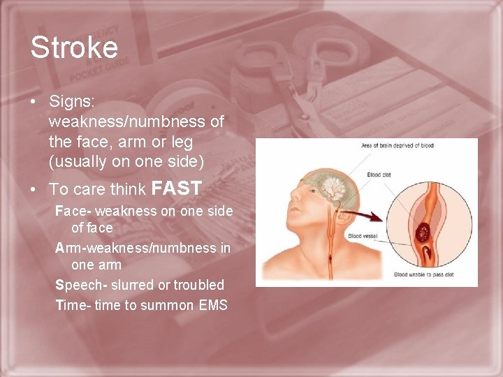 Stroke • Signs: weakness/numbness of the face, arm or leg (usually on one side)