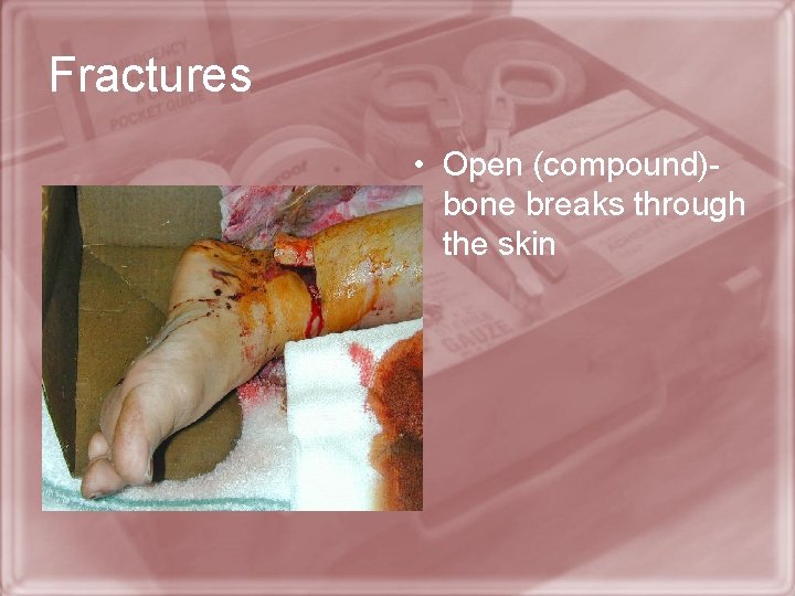 Fractures • Open (compound)bone breaks through the skin 