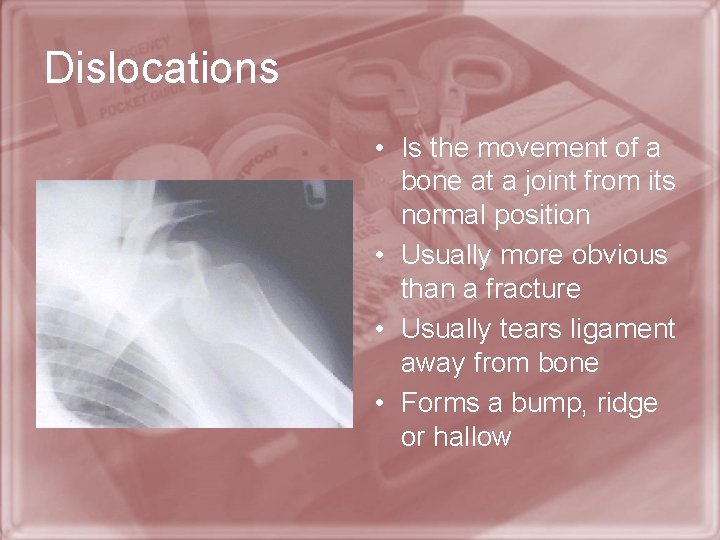 Dislocations • Is the movement of a bone at a joint from its normal