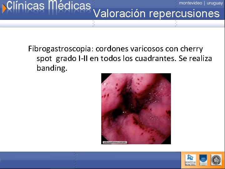 Valoración repercusiones Fibrogastroscopia: cordones varicosos con cherry spot grado I-II en todos los cuadrantes.