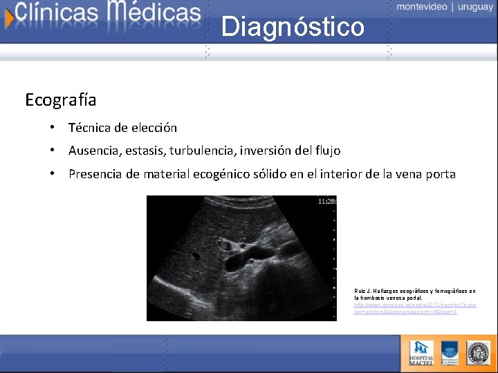 Diagnóstico Ecografía • Técnica de elección • Ausencia, estasis, turbulencia, inversión del flujo •